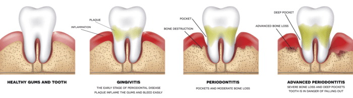 periodontal therapy calgary ab dentist