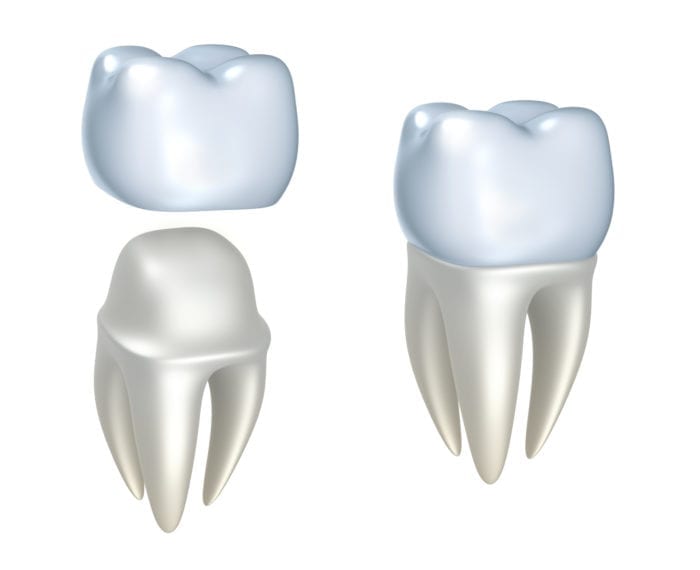 Foothills Dentistry offers dental crowns in calgary ab