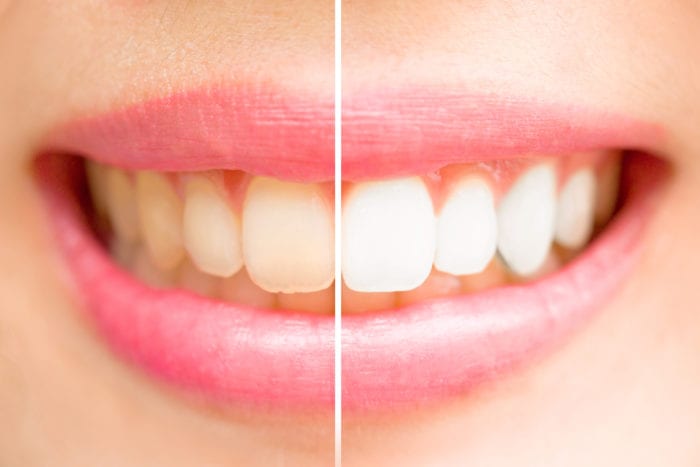 affordable teeth whitening in Calgary, Alberta CA