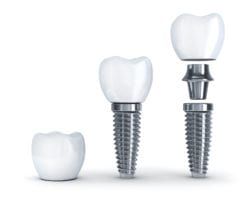 Foothills Dentistry offers dental implants in Calgary AB