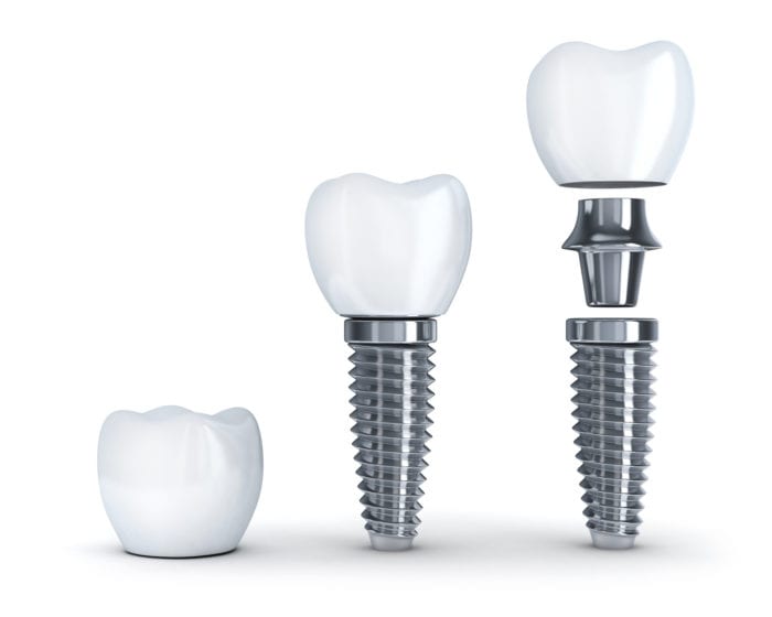 dental implants in Calgary, Alberta