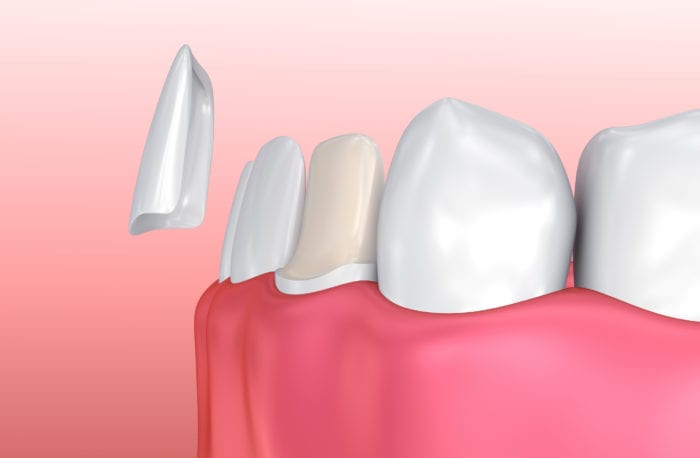 affordable porcelain veneers