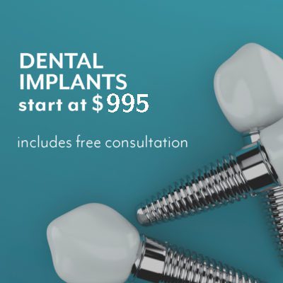 Calgary AB Dental Implants starting at $995