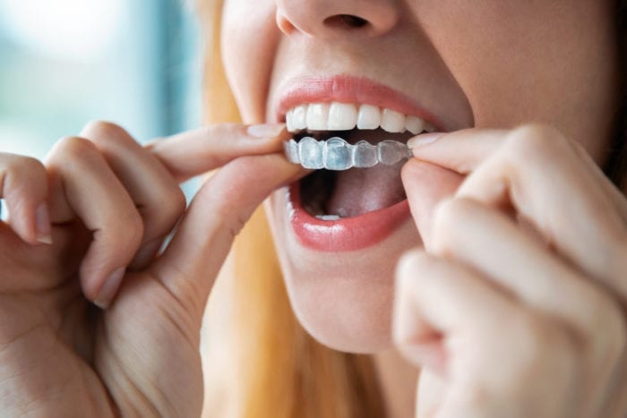 Invisalign Treatment in Calgary, Alberta