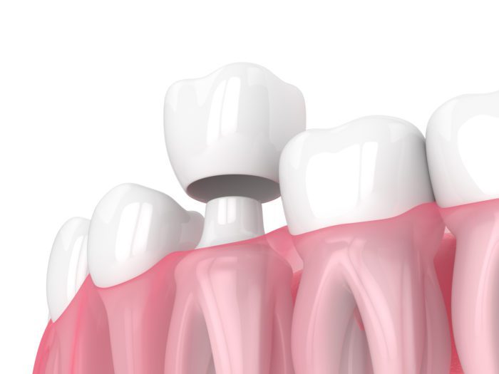 Dental Crowns in Calgary, Alberta