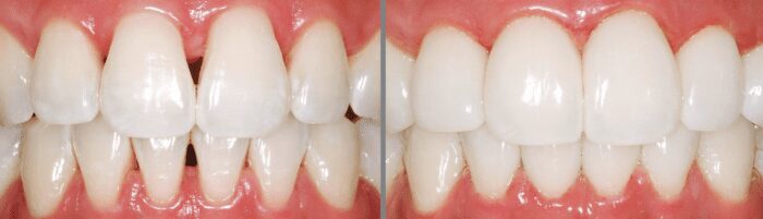 treating dental triangles with bioclear in calgary ab