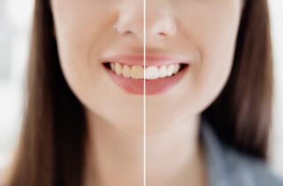 Tooth Stains in Calgary, Alberta