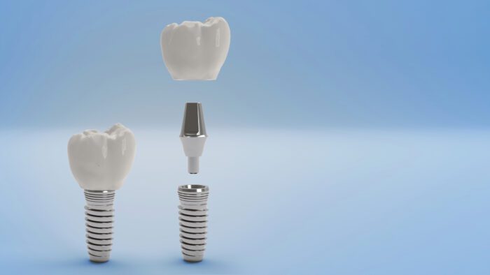 What to know about dental implants in Calgary, AB