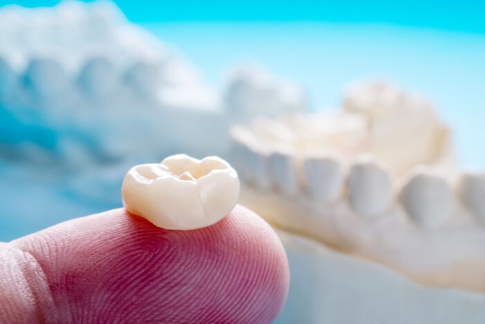 When Do You Need Dental Crowns?