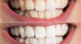 Treat Your Teeth this Holiday with Tooth Whitening