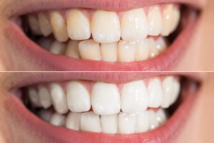 Teeth whitening in Calgary, AB, could help you get holiday ready