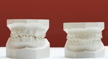 The Invisalign Advantage