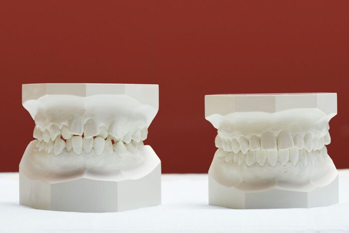 Invisalign in Calgary, AB, can help adjust your smile and improve your bite