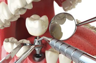 dental implants in Calgary, AB can help restore your bite, but they aren't for everyone