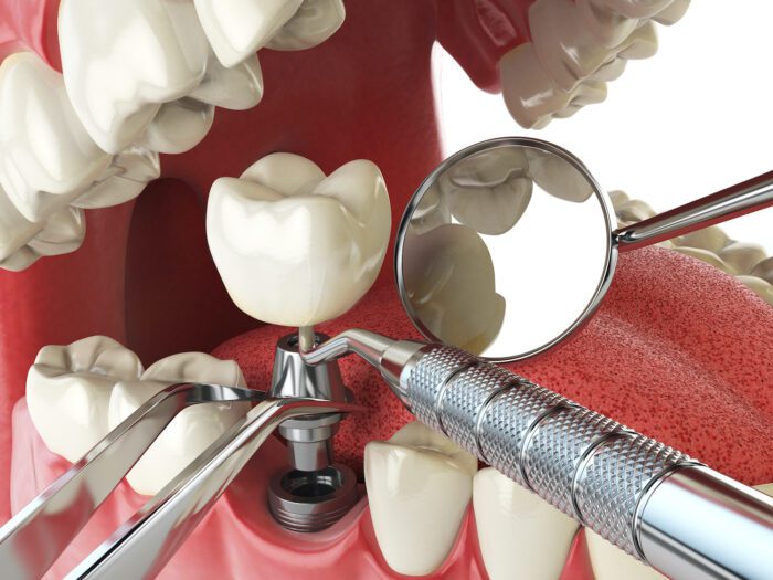 dental implants in Calgary, AB can help restore your bite, but they aren't for everyone