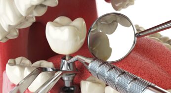 Are You a Good Candidate for Dental Implants?