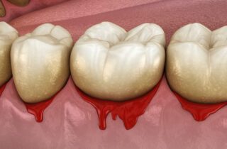 bleeding gums in Calgary, AB, could point to a serious dental condition.