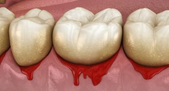 Bleeding Gums: What it Means and What to do