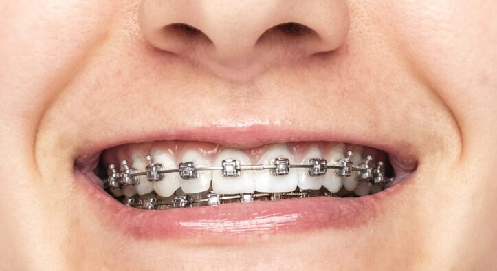 Why Choose Metal Braces for Adults